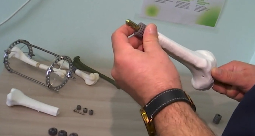 В Кургане провели первую в мире операцию по экспресс-восстановлению кости с помощью модульного имплантата