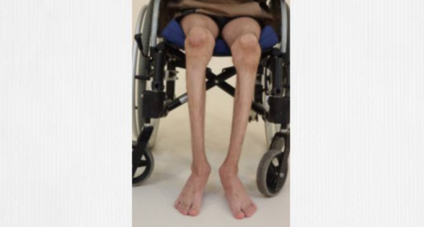 Благодаря медикам из Кургана 35-летний "хрустальный" пациент впервые за 18 лет встанет на ноги