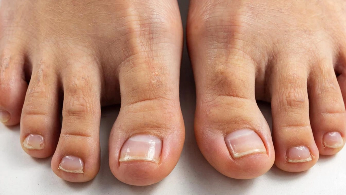 Толстые серо-желтые ногти после зимы: простой желатин и фен спасут ноги быстрее салонных процедур